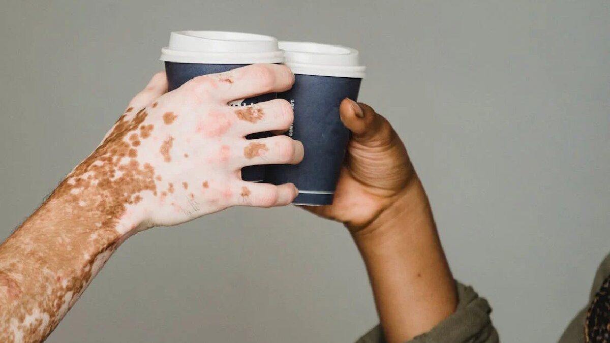 Why does the skin lose pigmentation?