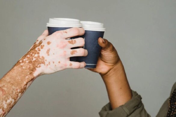 Why does the skin lose pigmentation?