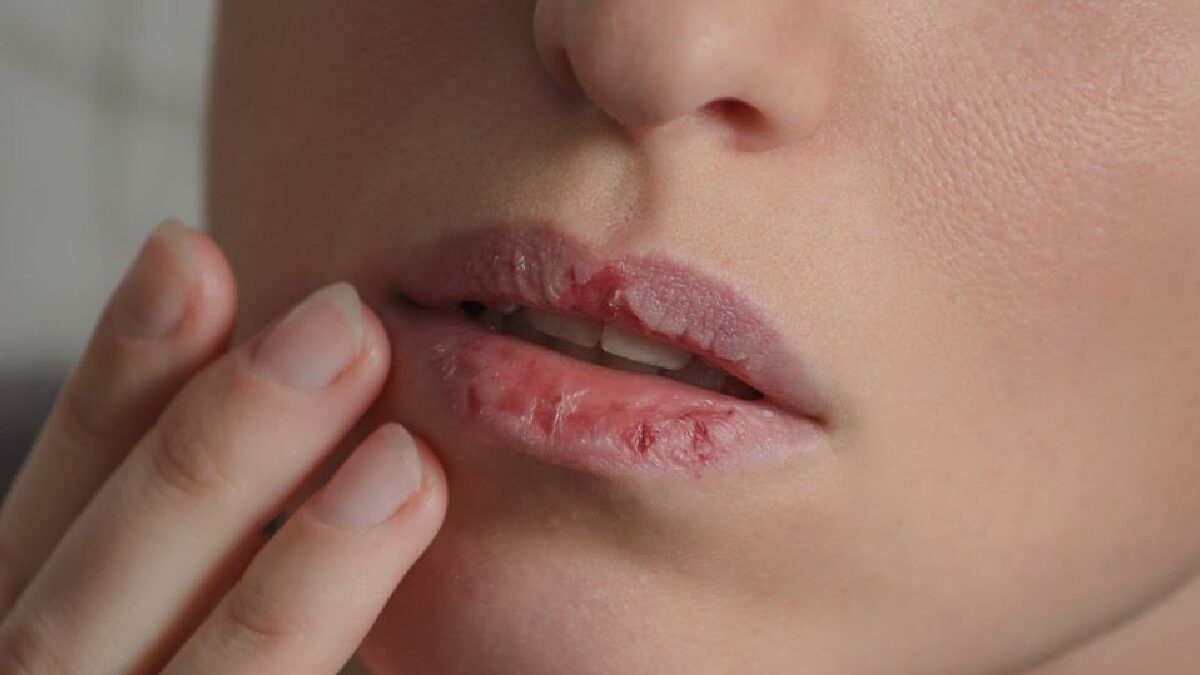 Dry Lips: Causes and Treatment