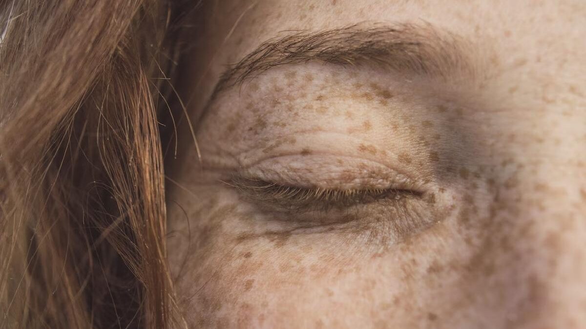 Only 5% of the world’s population has freckles.