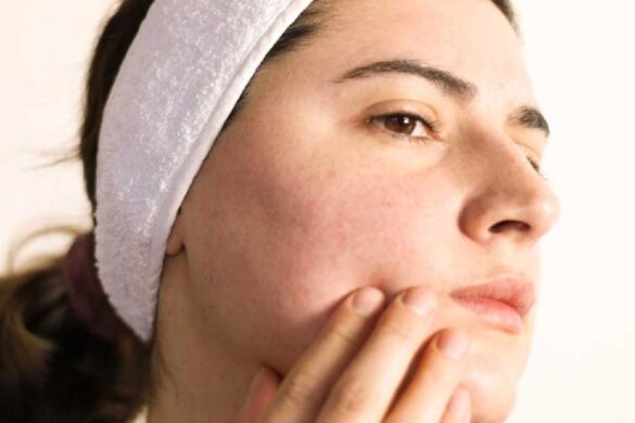 rosacea