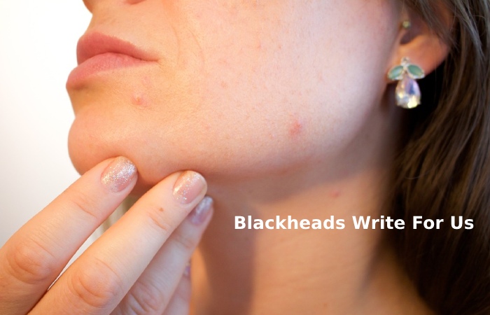 Blackheads Write For Us