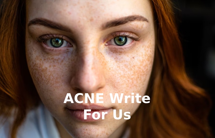 ACNE Write For Us 
