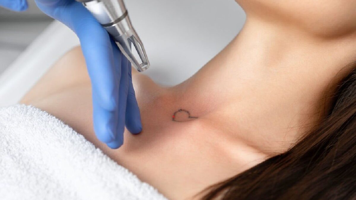 7 Things You Should Know About Laser Tattoo Removal