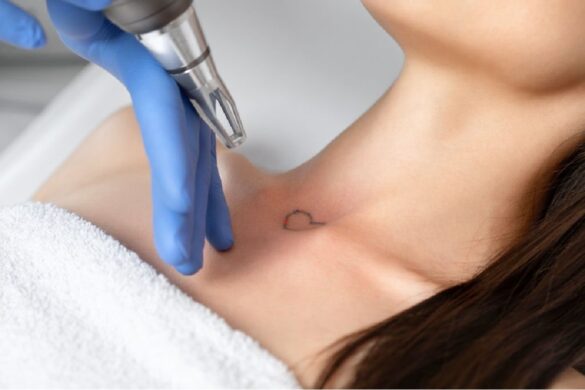7 Things You Should Know About Laser Tattoo Removal