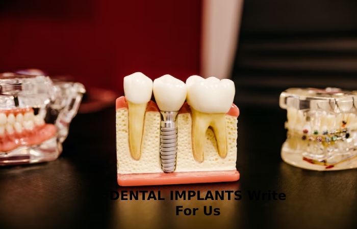DENTAL IMPLANTS Write For Us
