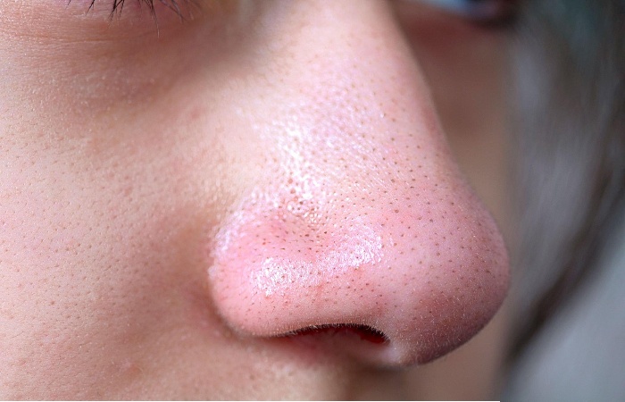 Blackheads Write For Us