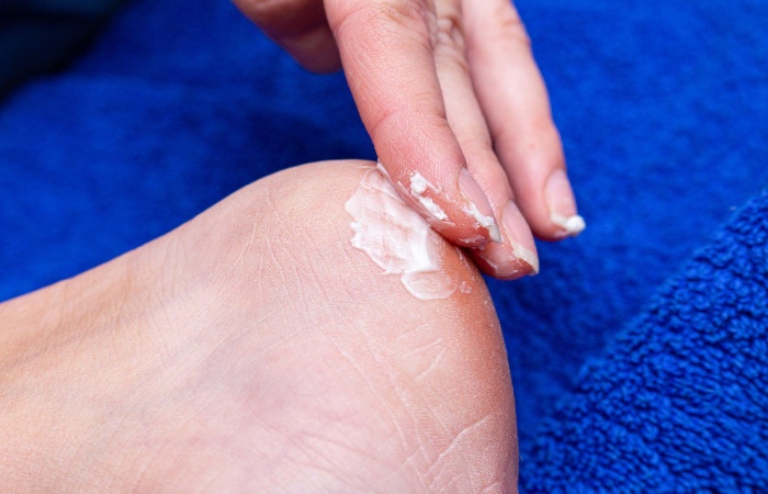 Callus Softening Creams