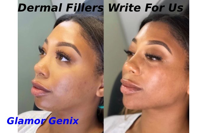 Dermal Fillers Write For Us