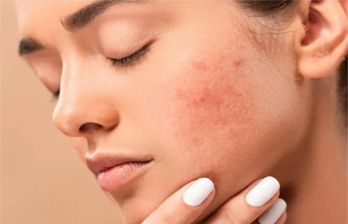 Dark Spots Write For Us